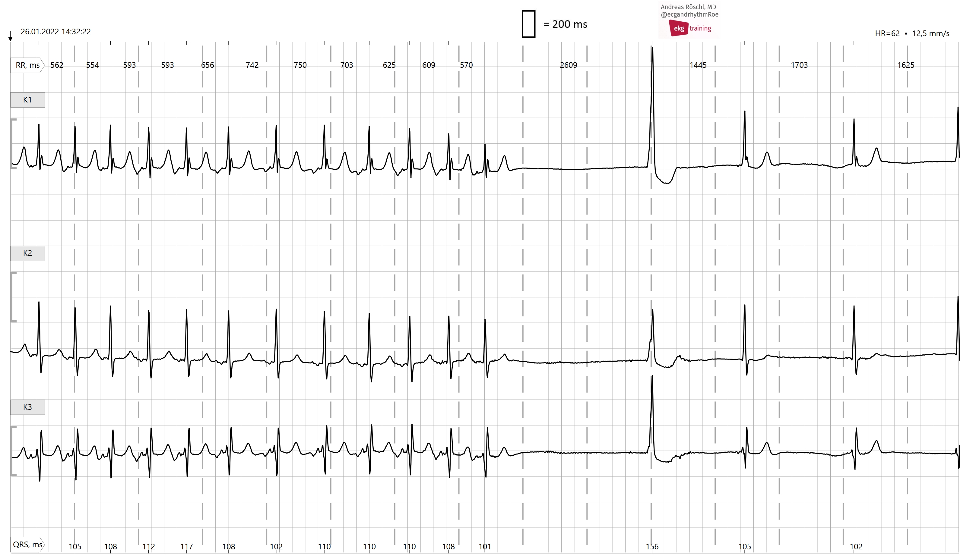 Preautomatic pause ECG Guru Instructor Resources